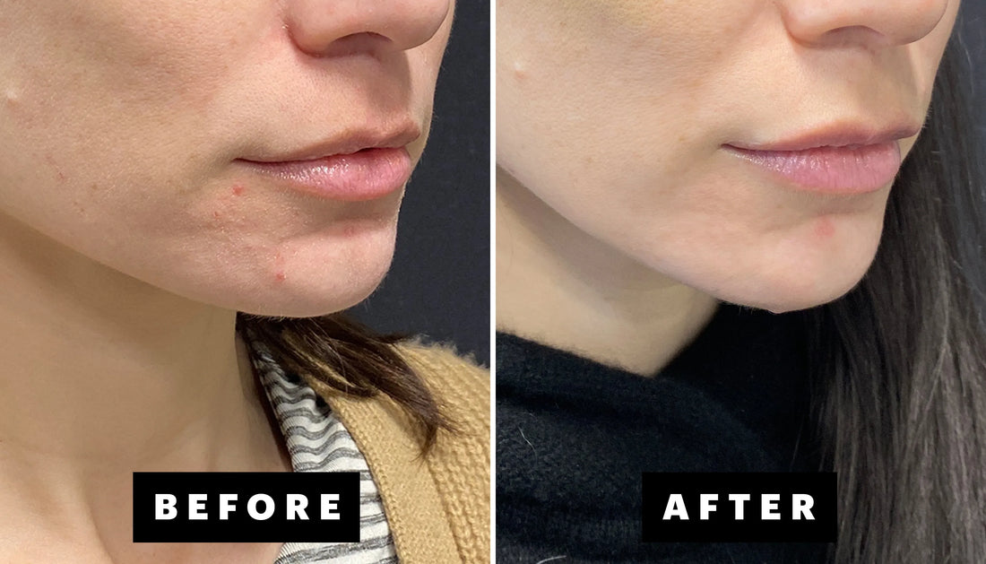 I Tried the New AviClear Laser for My Hormonal and Cystic Acne